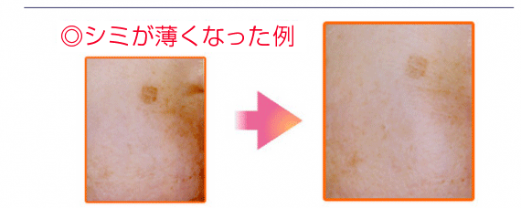 シミが薄くなった例